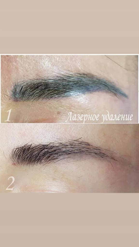 Фото услуги Лазерное удаление тату
