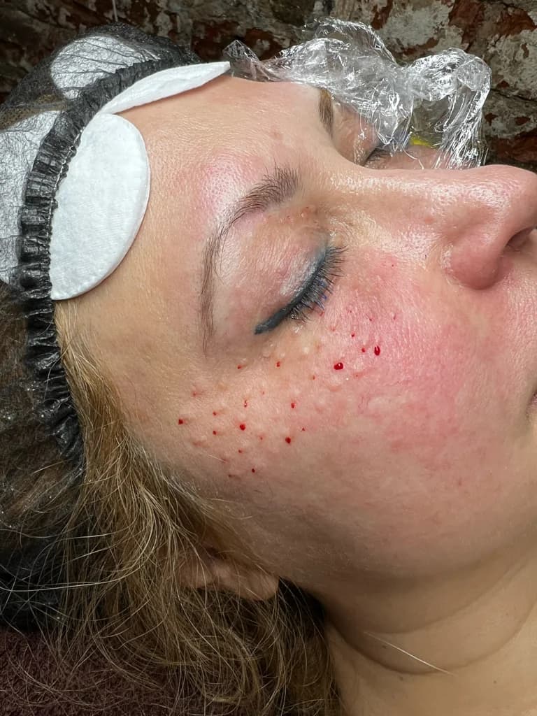 Фото услуги Revita bio eyes   (ревита)  «контургель-хпм» 1мл биоревитализация для кожи вокруг глаз   интенсивное увлажнение, разглаживание морщин