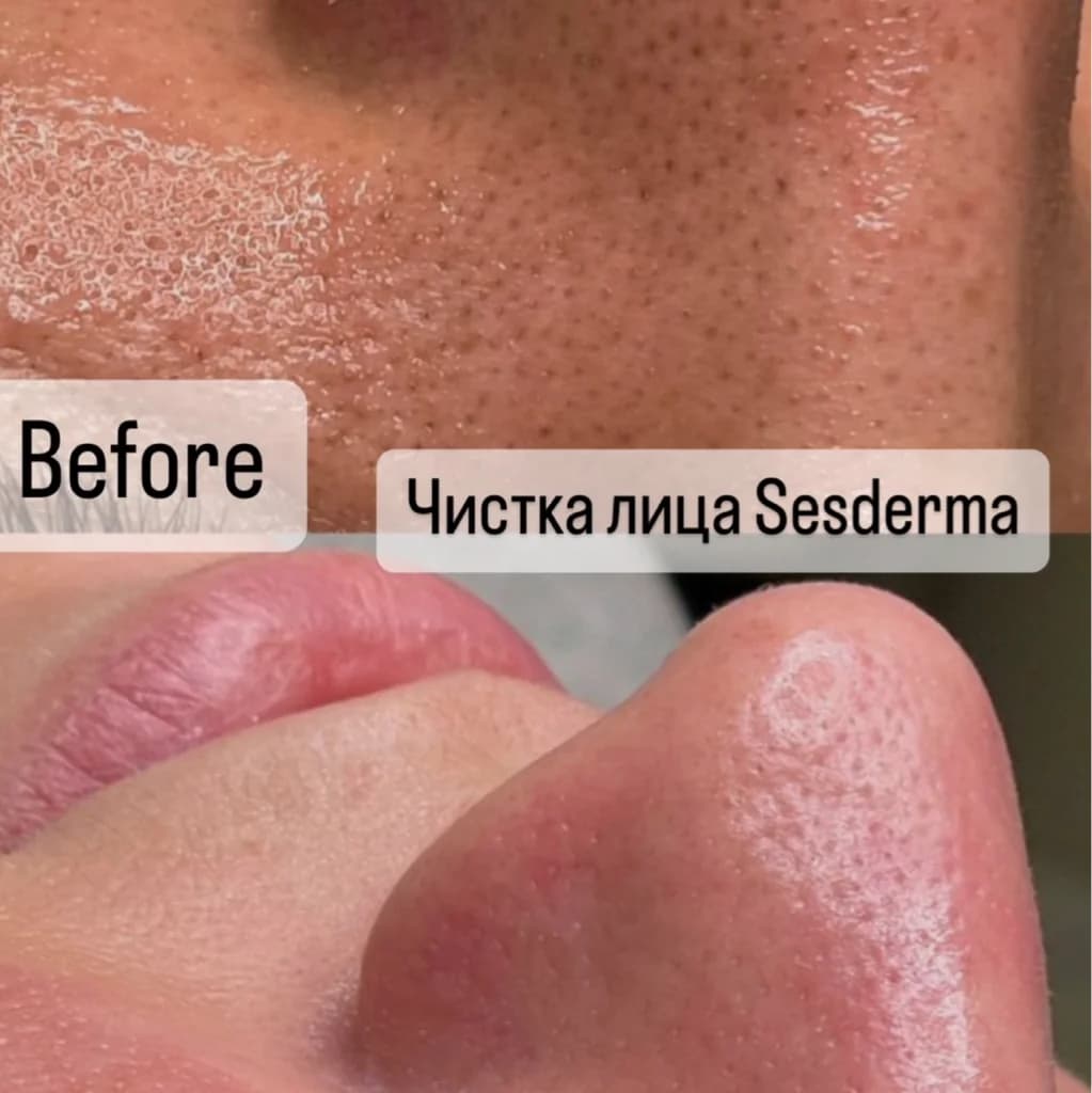 Фото услуги Ультразвуковая чистка лица sesderma