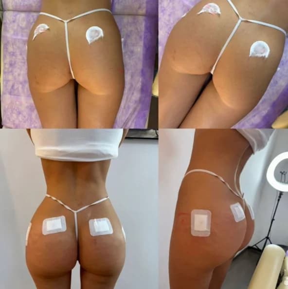 Записаться на услугу Увеличение ягодиц  (корея)   💉 tesoro body 60 ml