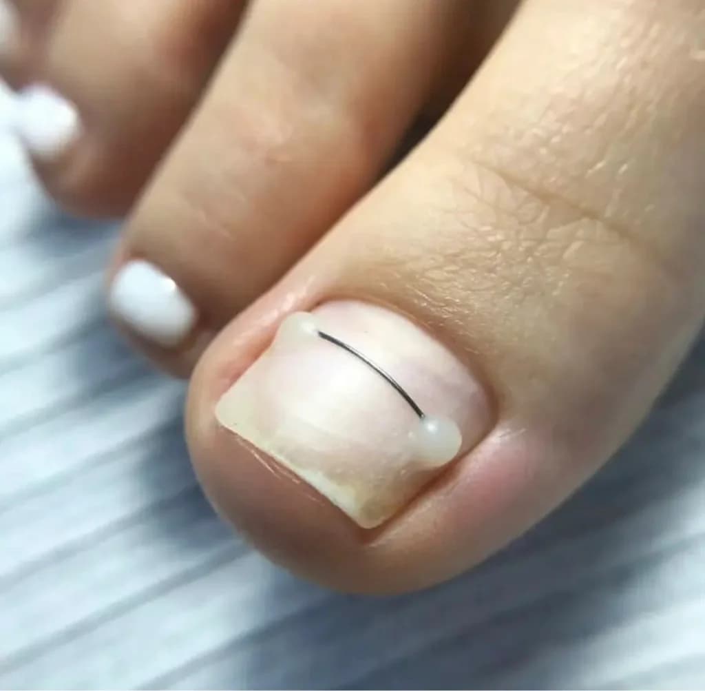 Фото услуги Коррекция ногтя титановой нитью