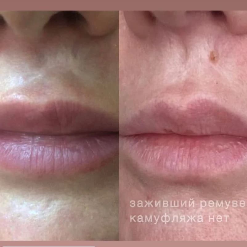 Записаться на услугу Коллагенотерапия шрамов и рубцов