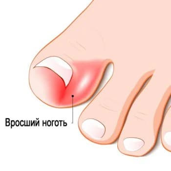 Фото услуги Коррекция вросшего ногтя || степени