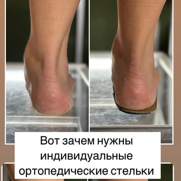 Фото услуги Изготовление стельки индивидуальные ( ортопедические ).