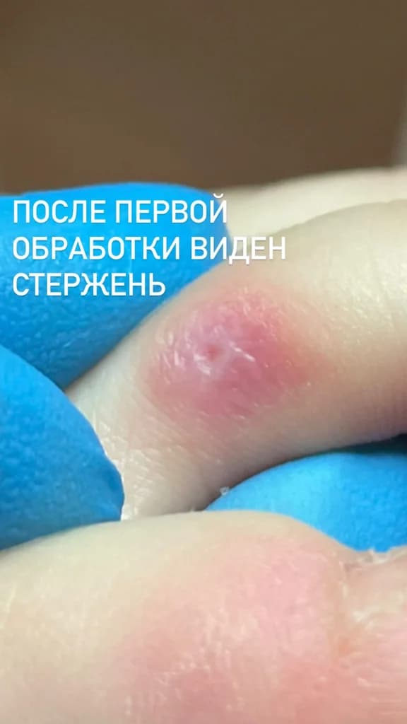Ещё 7 фото услуги Удаление стержневых мозолей