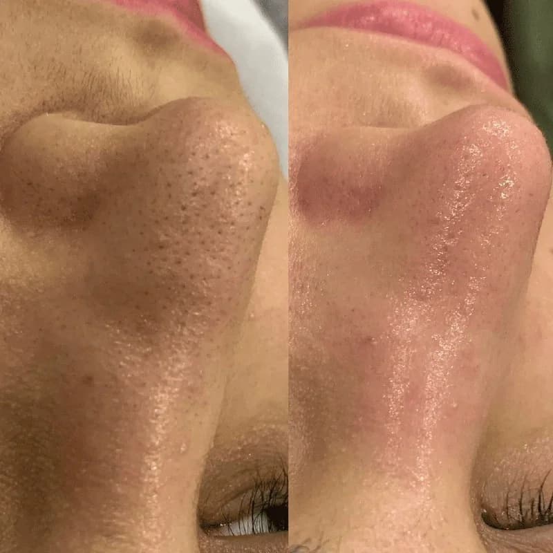 Записаться на услугу Программа "anti-acne" (очищение и уход)