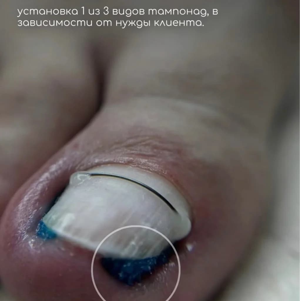Записаться на услугу Тампонада