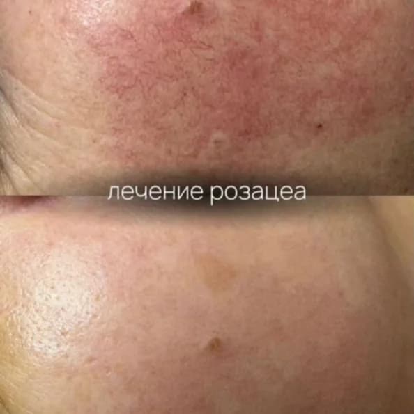 Фото услуги Удаление купероз