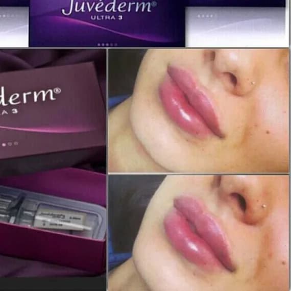 Записаться на услугу Коррекция формы и объёма губ juvederm ultra smile