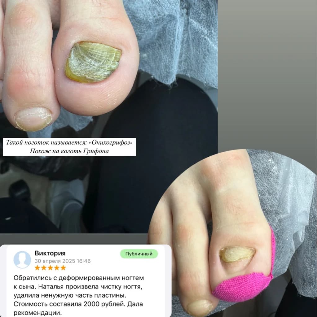 Фото услуги Зачистка ногтя онихогрифоз 2000
