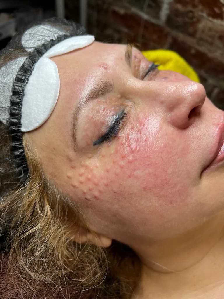 Фото услуги Revita bio eyes   (ревита)  «контургель-хпм» 1мл биоревитализация для кожи вокруг глаз   интенсивное увлажнение, разглаживание морщин