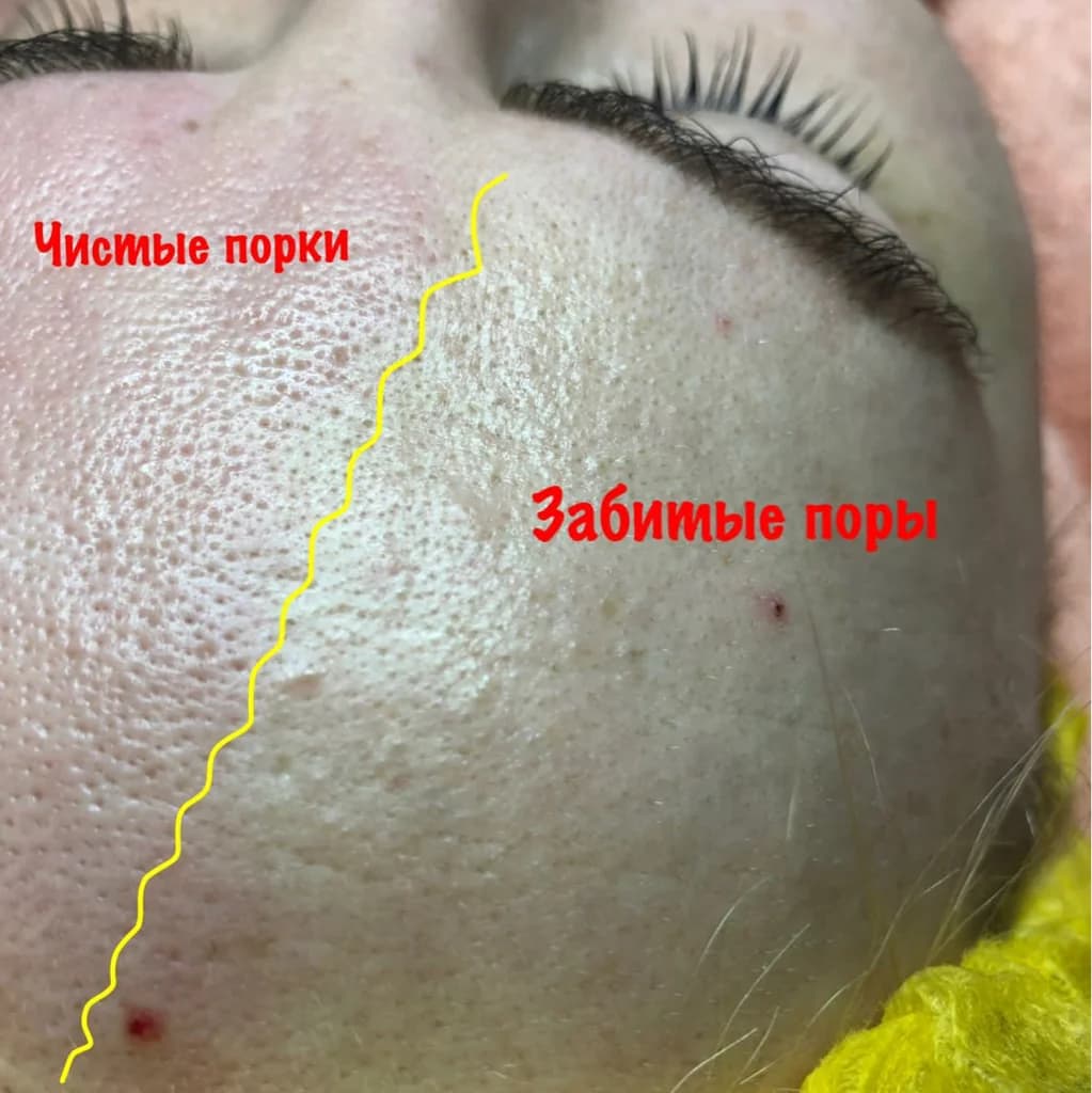Фото услуги Чистка лица ультразвуковая/механическая