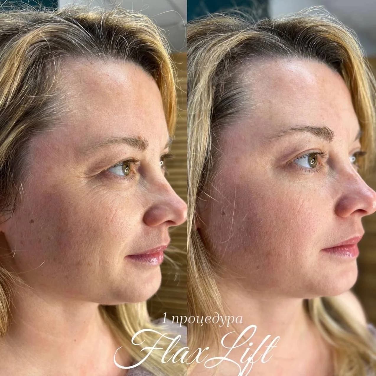 Фото услуги Flaxlift (восстановление тонуса кожи)