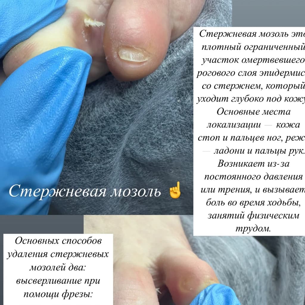 Записаться на услугу Удаление стержневой мозоли 1200