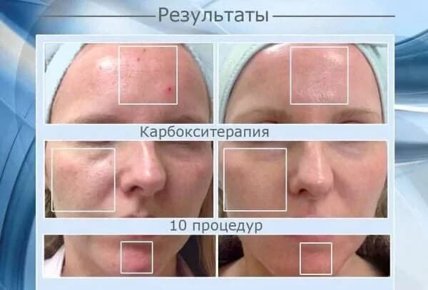 Фото услуги Карбокситерапия со2
