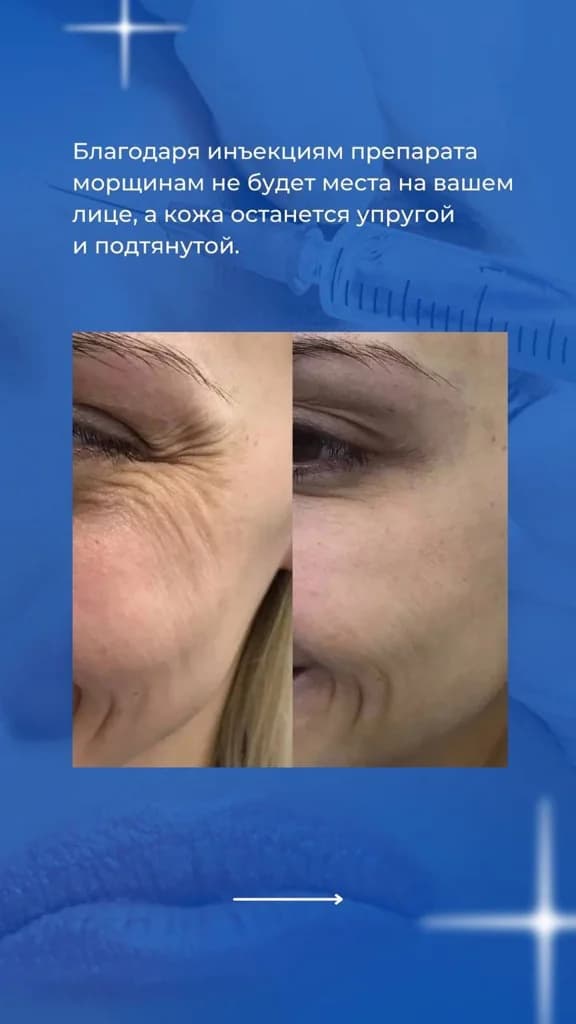 Фото услуги Ботокс двух зон