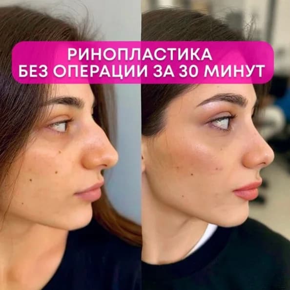 Записаться на услугу Ринопластика носа