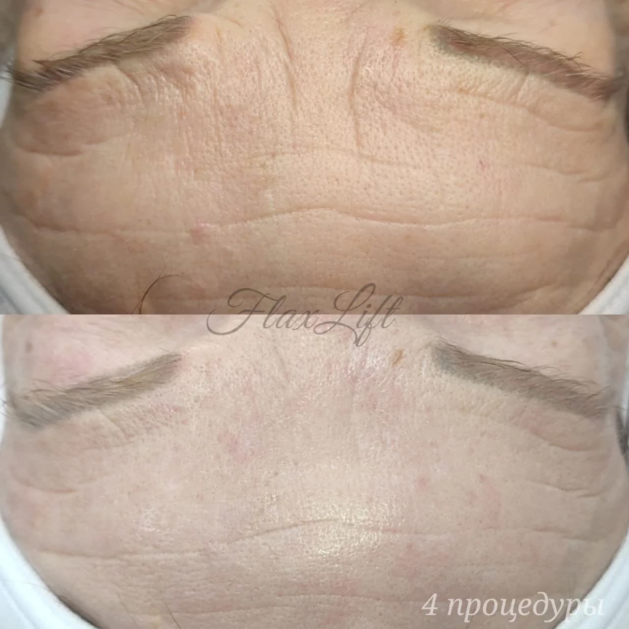 Ещё 2 фото услуги Flaxlift (восстановление тонуса кожи)