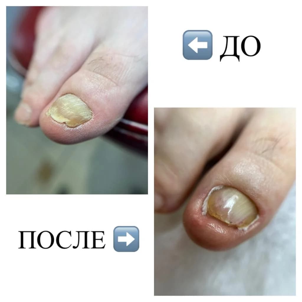 Фото услуги Зачистка всех пальчиков при онихогрифозе и грибке