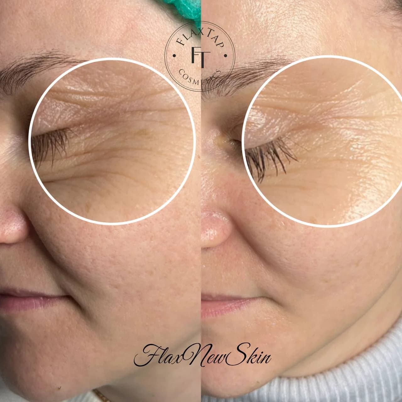 Фото услуги Flaxnewskin (липосомальное обновление кожи)