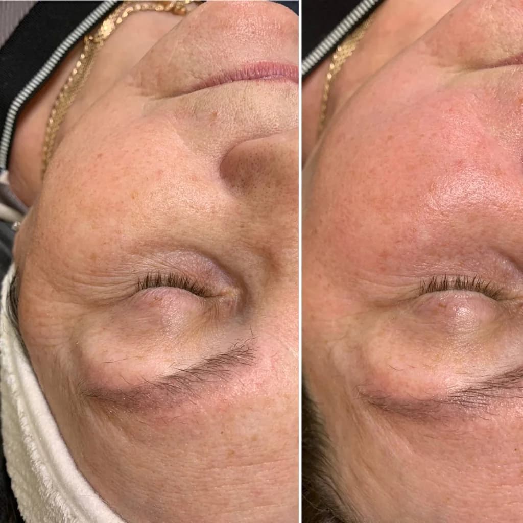 Ещё 1 фото услуги Flaxenzyme (ферментотерапия) лицо