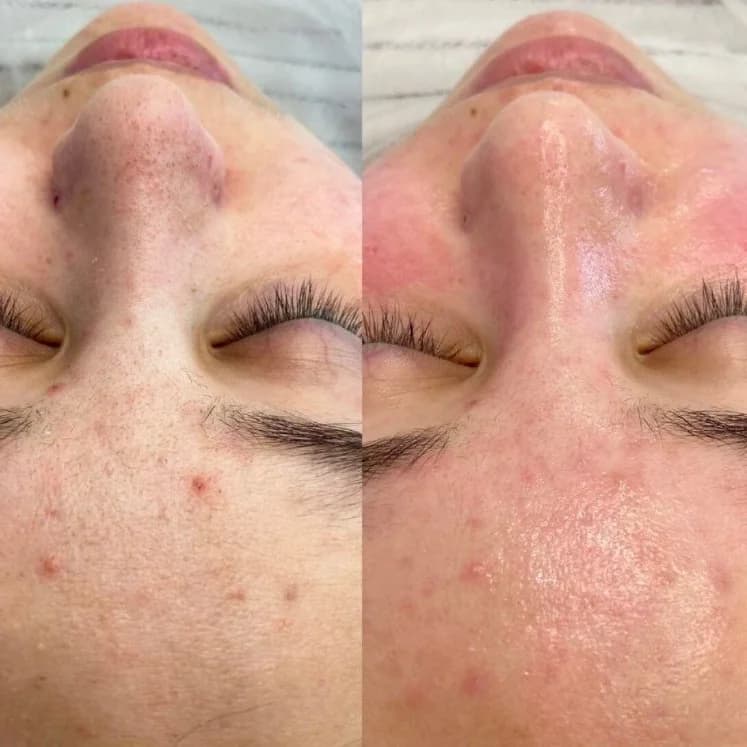 Фото услуги Программа "anti-acne" (очищение и уход)