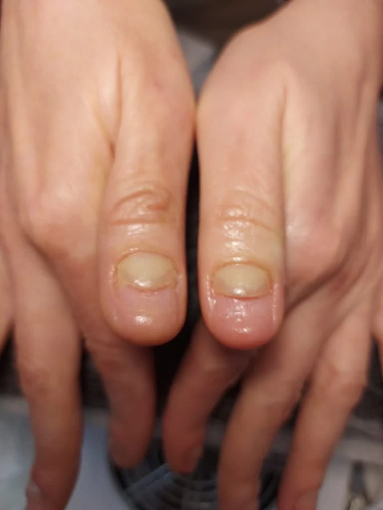 Фото услуги Зачистка онихолизиса