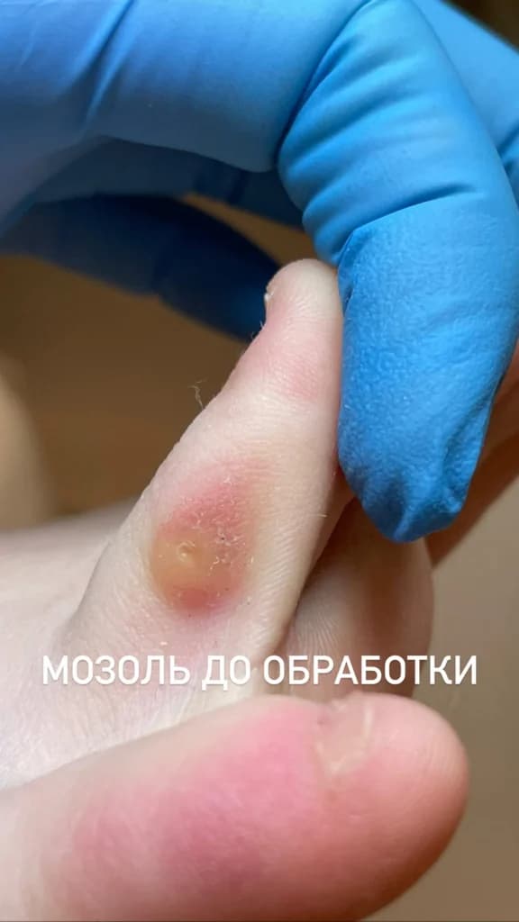 Фото услуги Удаление стержневых мозолей