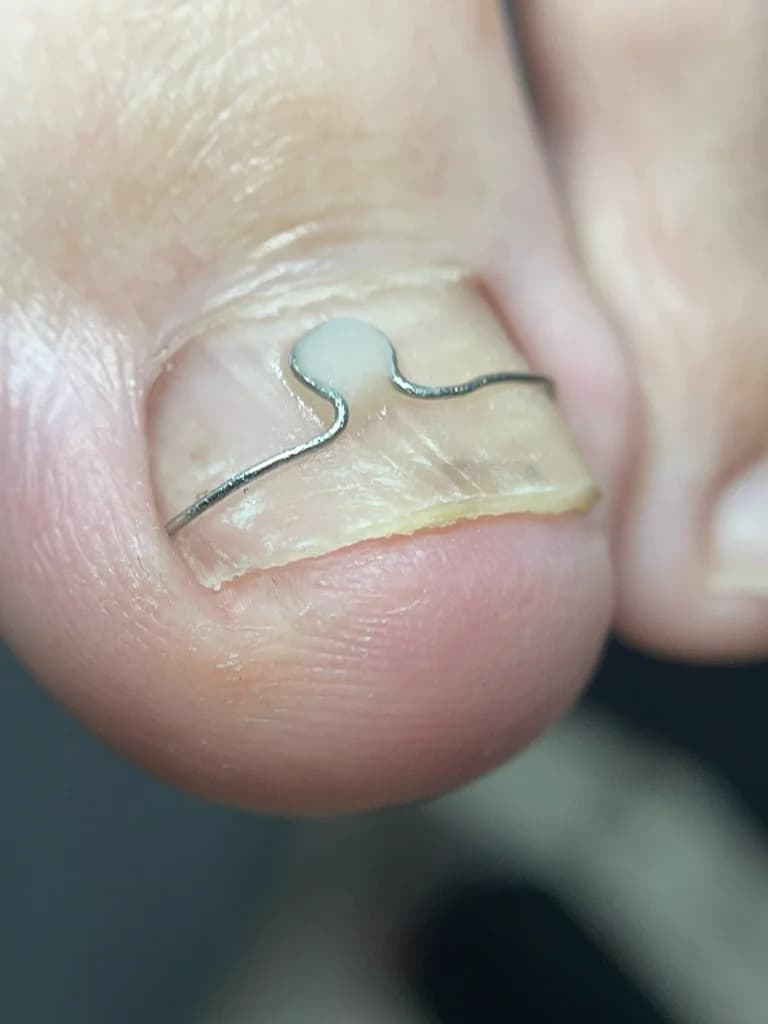 Ещё 1 фото услуги Установка корректирующей крючковой системы/ коррекция