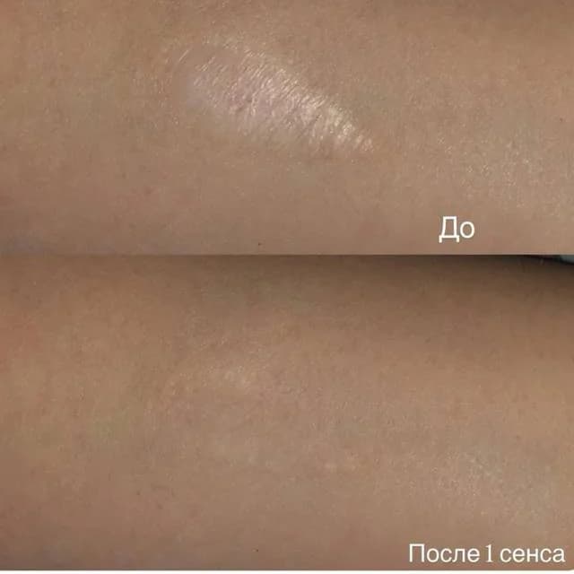 Фото услуги Коррекция шрамов