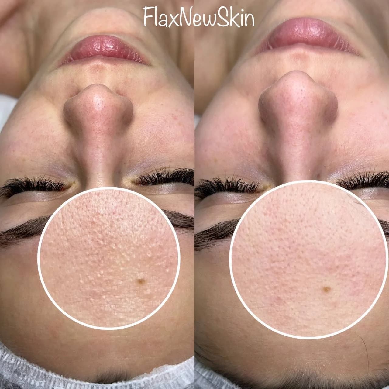 Фото услуги Flaxnewskin (липосомальное обновление кожи)