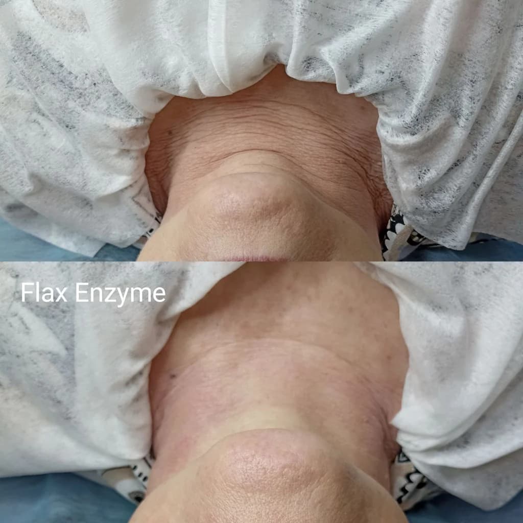 Фото услуги Flaxenzyme (ферментотерапия) лицо и шея