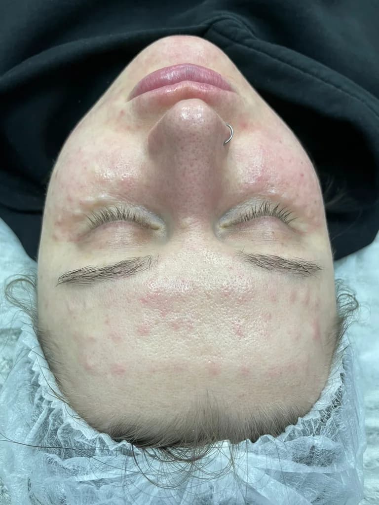 Фото услуги Биоревитализация+коллагеностимуляция в одном шприце.  neauvia organic hydro delux