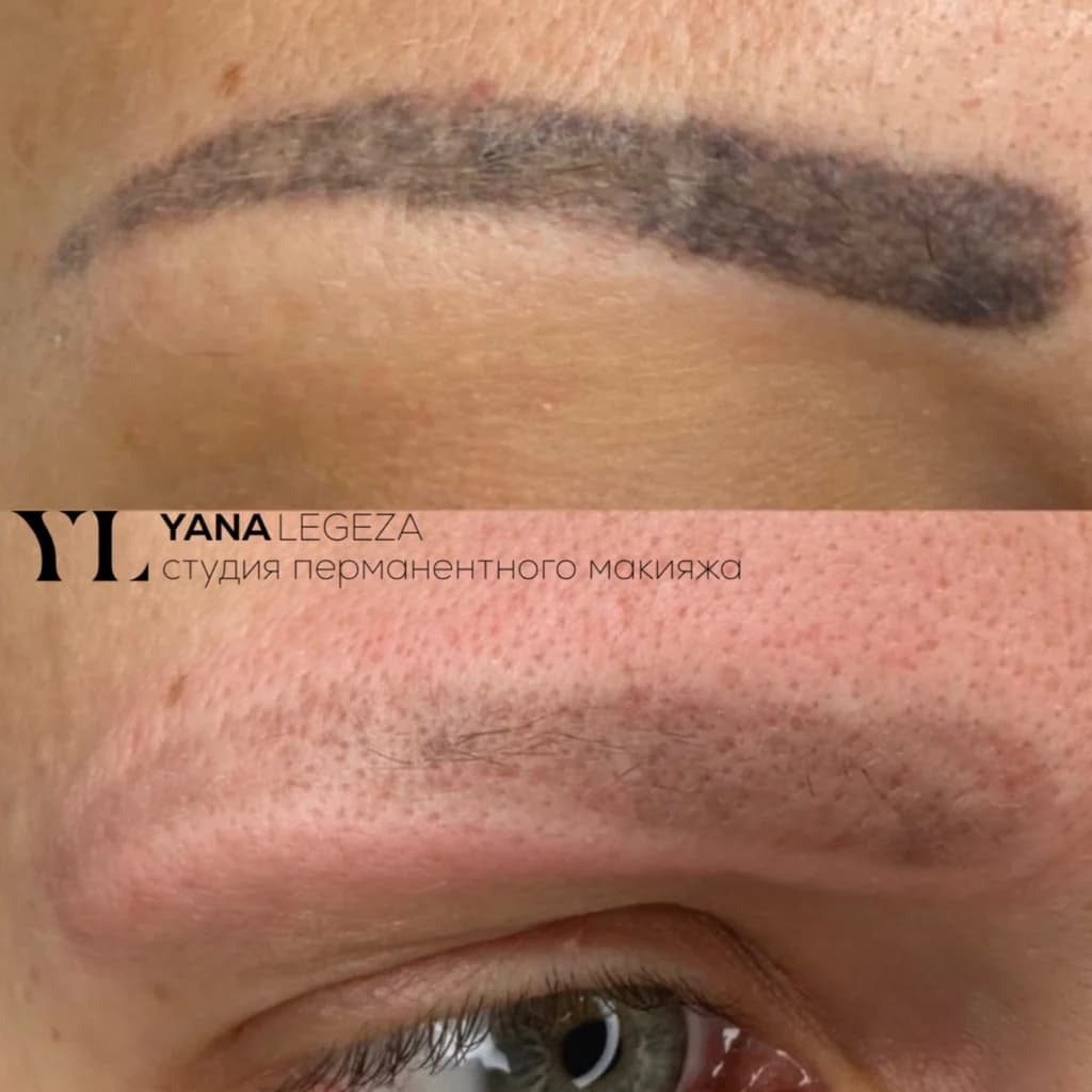 Фото услуги Удаление татуажа комби-техника (лазер + ремувер)