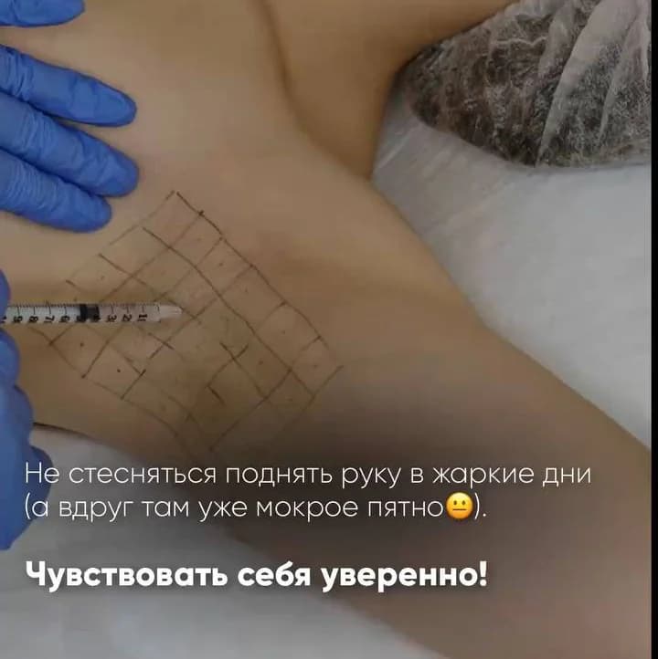 Записаться на услугу Коррекция гипергидроза-потливости любая зона