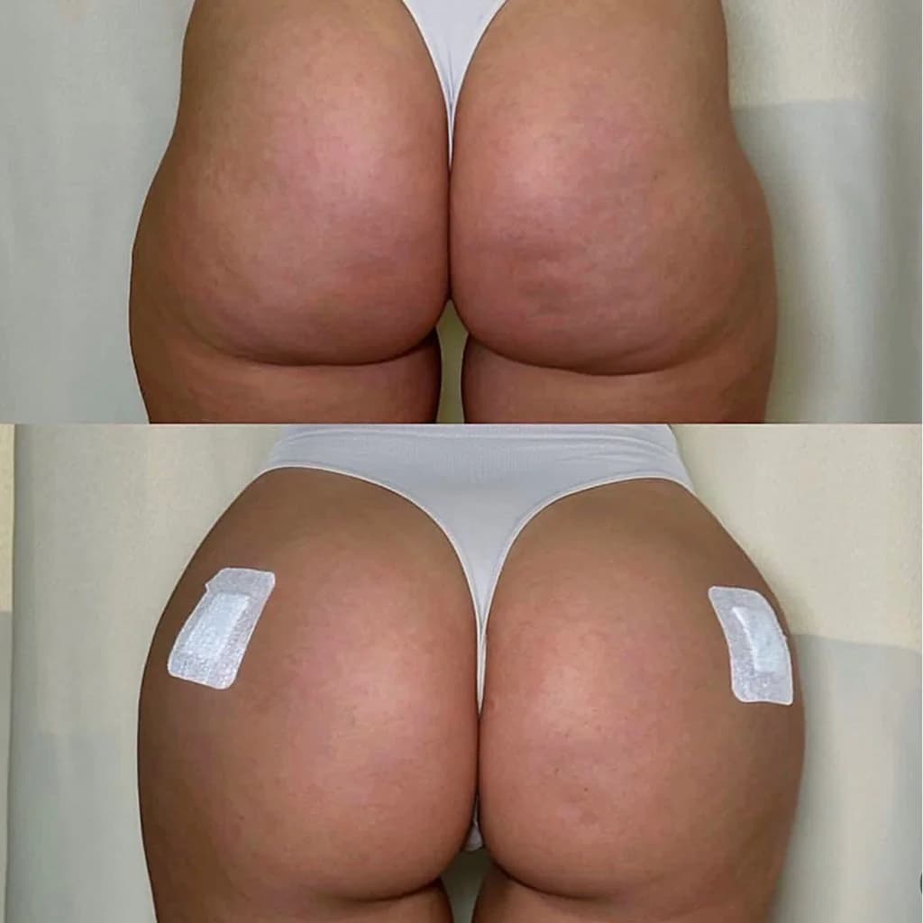 Записаться на услугу Увеличение ягодиц  (франция)    💉rg body filler 100ml