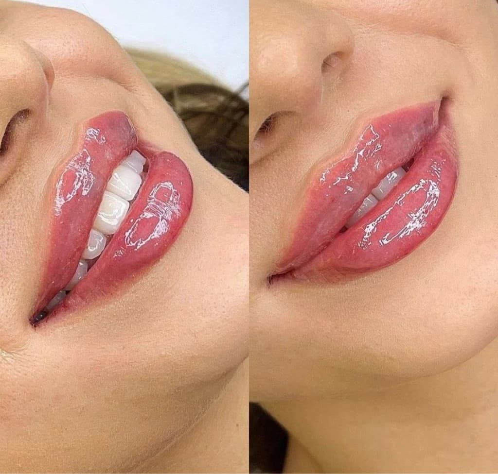 Фото услуги Увеличение губ   франция 
💉stylage м (стилаж м) 1 мл.