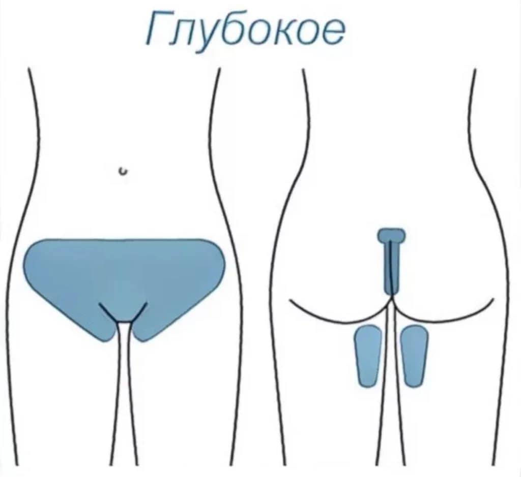 Фото услуги Депиляция женская - глубокое бикини (сахар)