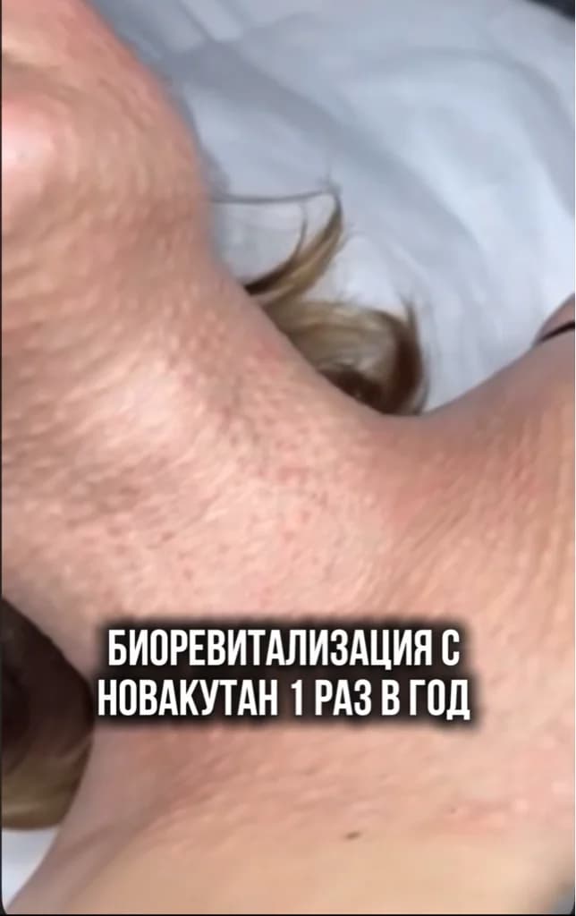 Фото услуги Биоревитализация новакутан-достаточно одной процедуры.