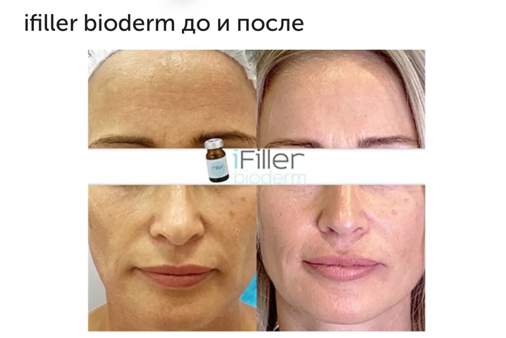 Фото услуги Ifiller bioderm (биодерм)      💥большой объем 5 мл💥 (италия)    биоревиталицация  невероятное сияние и омоложение кожи лица