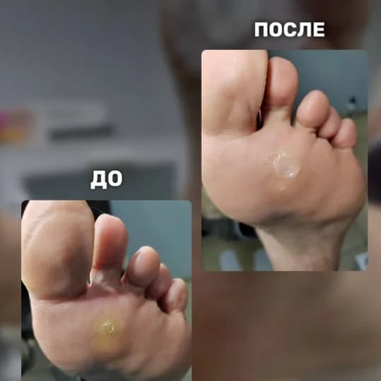 Записаться на услугу Удаление стержневой мозоли,бородавка