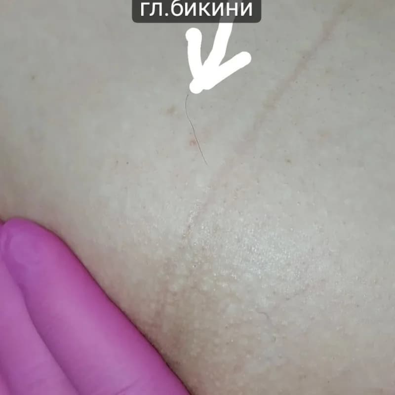 Пример работы Электроэпиляция agent_electroepil (9)