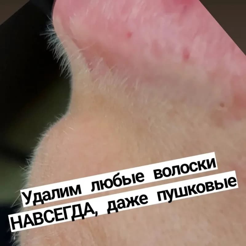 Пример работы Электроэпиляция agent_electroepil (5)