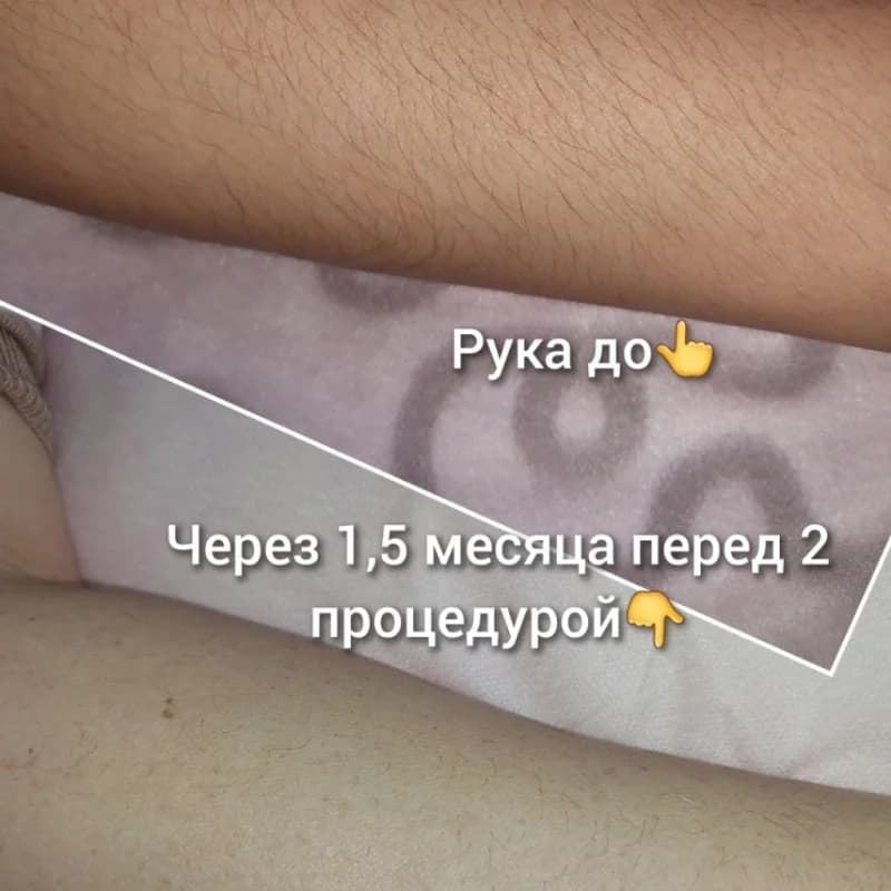 Пример работы Электроэпиляция agent_electroepil (7)