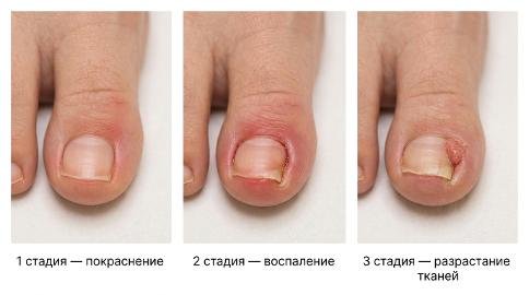 Стадии вросшего ногтя на ноге